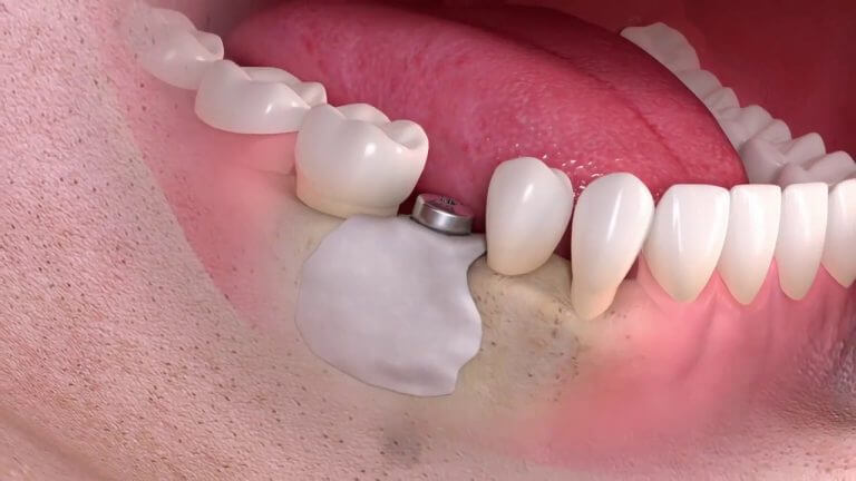 3D изображение зубного импланта в полости рта