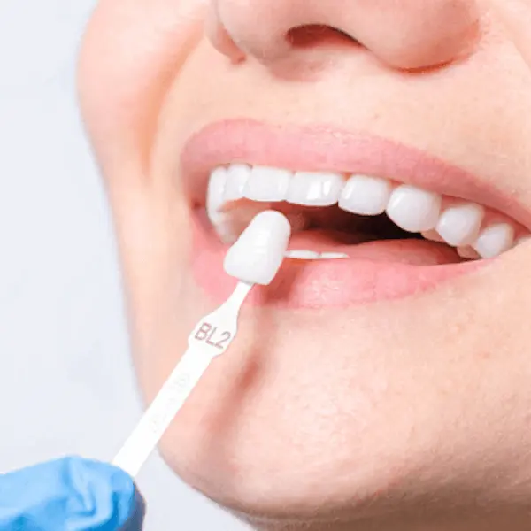 Подбор оттенка зуба для протезирования