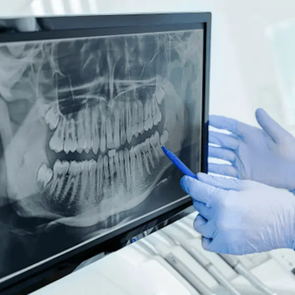 Стоматолог указывает на панорамный рентгеновский снимок